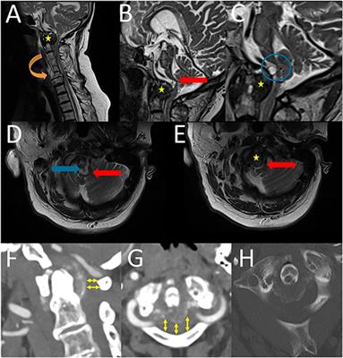 Case Report: Posterolateral Epidural Supra-C2-Root Approach (PESCA) for Biopsy of a Retro-Odontoid Lesions in Same Sitting After Occipitocervical Fixation and Decompression in a Case of Crowned Dens Syndrome With Brainstem Compression and Displacement